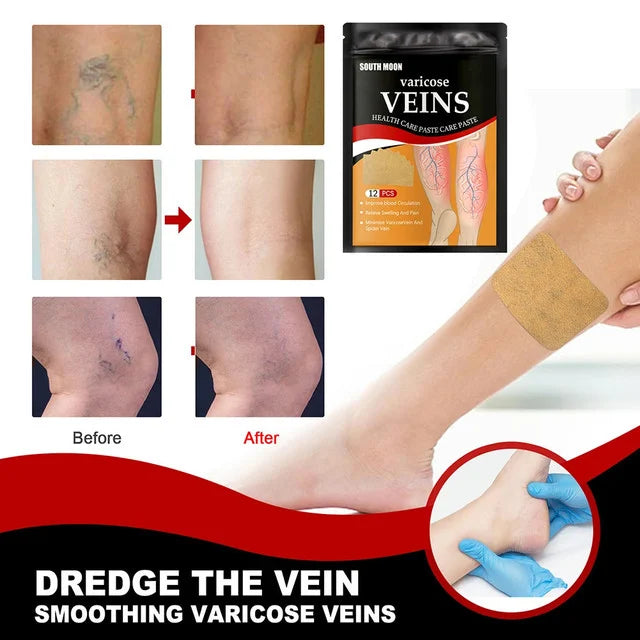 Varicose Vein Treatment Patch ( 12 Pcs)