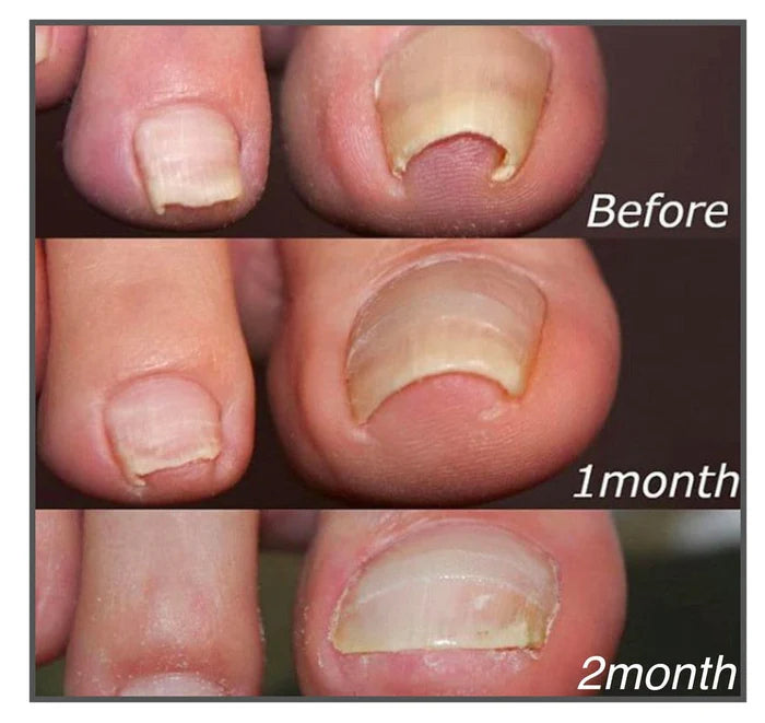Correction patches for beautiful and healthy nails (50 pcs)
