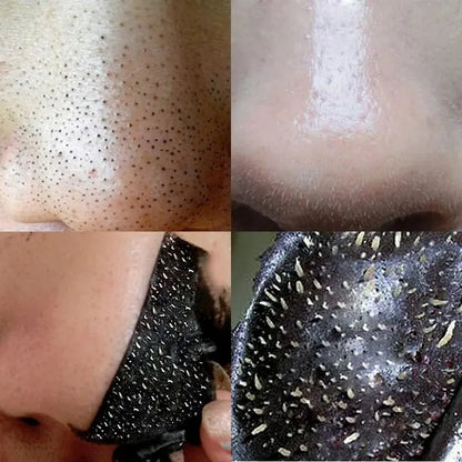 Deep Cleansing Blackhead Removal Nose Strips – Shrink & Purify Pores